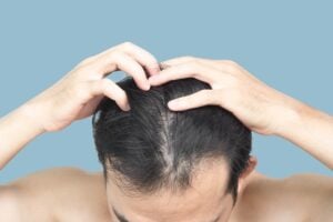 PRP Full Scalp Hair Restoration