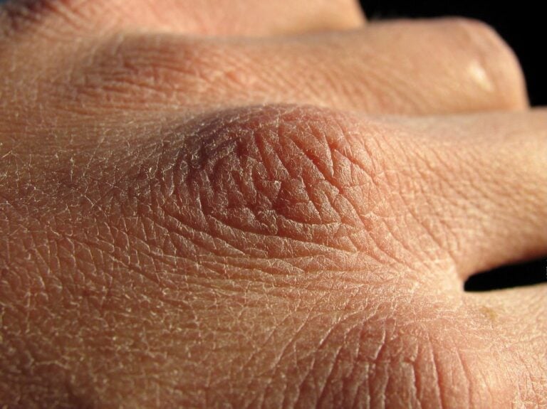 Dry Skin during Winters in New Hampshire