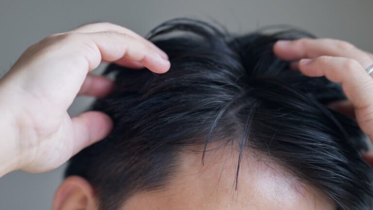 Hair Loss Prevention
