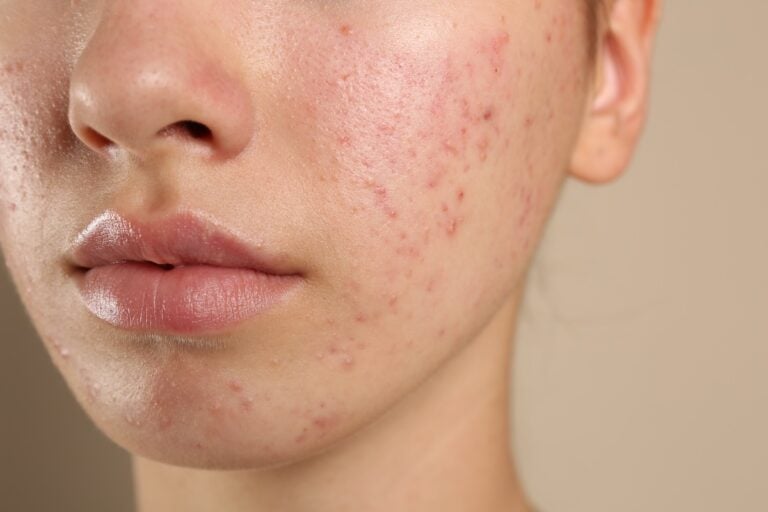 Summer Acne