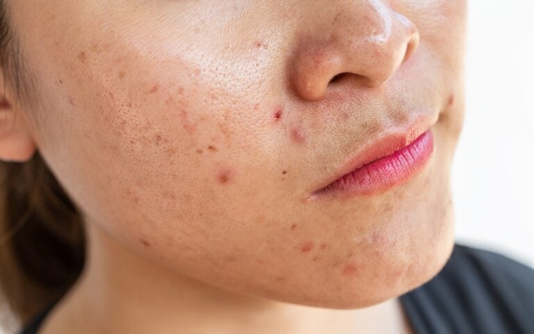 More than acne - when to see a dermatologist