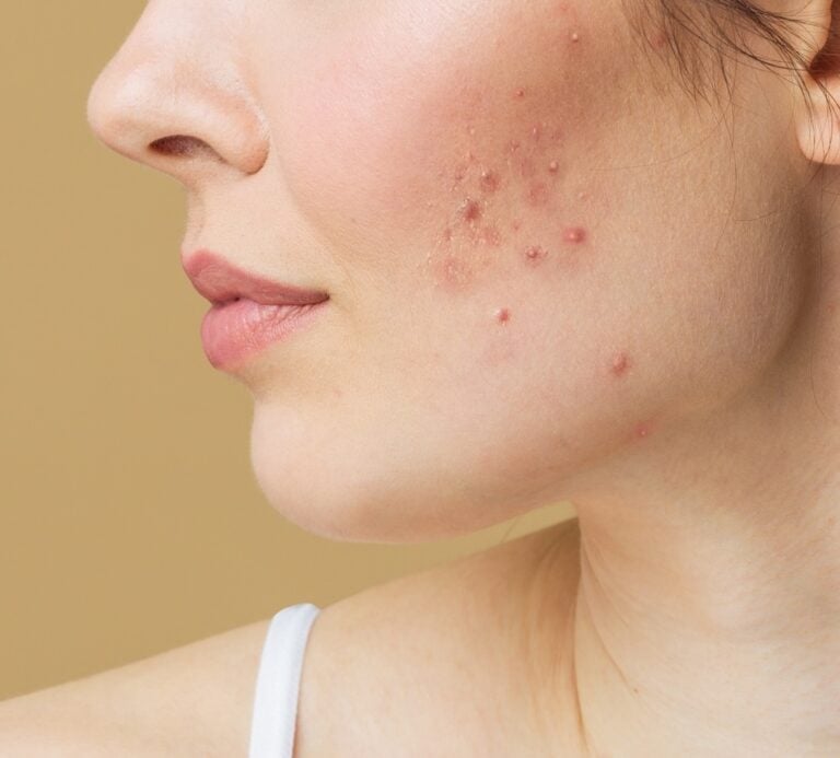 Acne